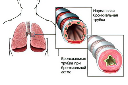 Бронхиальная астма у взрослых - первые признаки и симптомы, причины, лечение и диета при бронхиальной астме