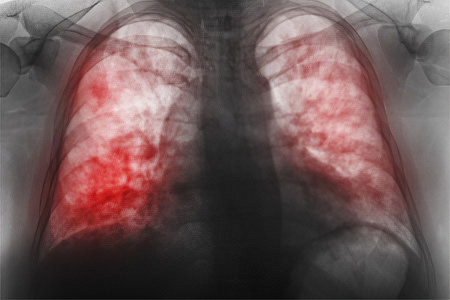 Двусторонняя пневмония – чем опасна? Первый признак, лечение