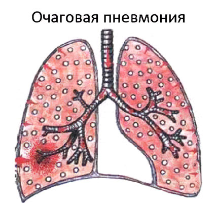 Очаговая пневмония: что это такое и как лечить?