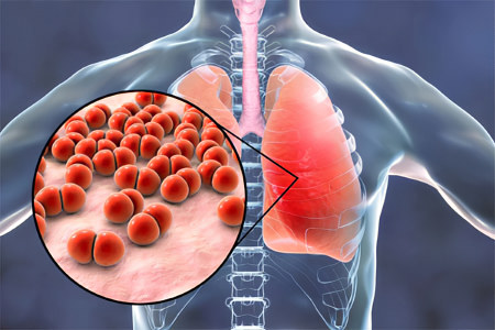 Правосторонняя пневмония - причины, симптомы и лечение